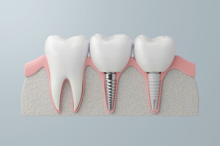 Affordable Dental Implants in Turkey | High-Quality Care